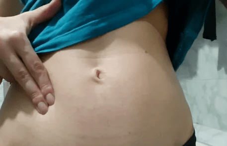 Inchazo abdominal por triquinose