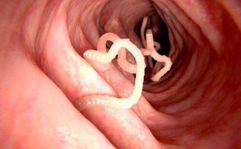 Vermes no corpo humano