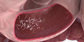 O uso de triplets para eliminar parasitos